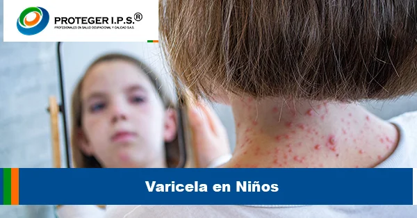 Varicela en Niños