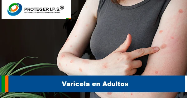 Varicela en Adultos