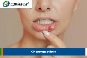 Citomegalovirus